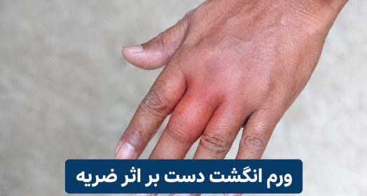 درمان خانگی ورم انگشت دست بر اثر ضربه