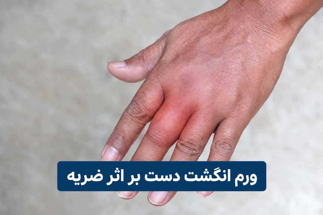 درمان خانگی ورم انگشت دست بر اثر ضربه